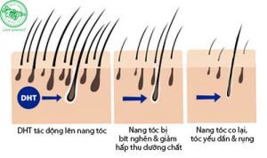 Rụng tóc do thay đổi hooc mon