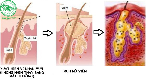 Quá trình mụn phát triển