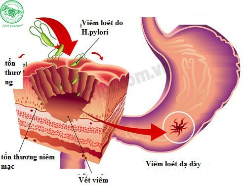 vi khuan HP