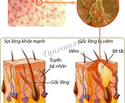 viêm nang lông hình thành như thế nào