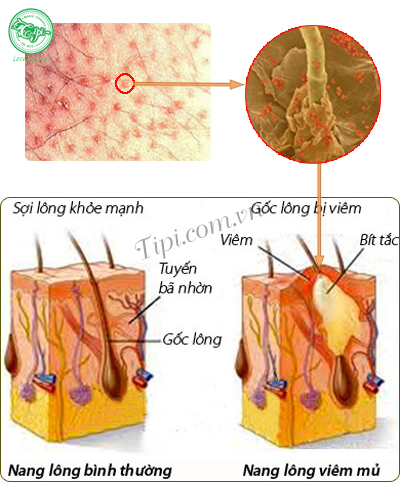 viêm nang lông hình thành như thế nào